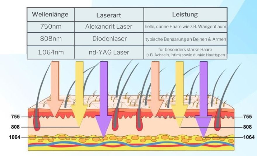 dauerhafte Haarentfernung Köln Schaubild